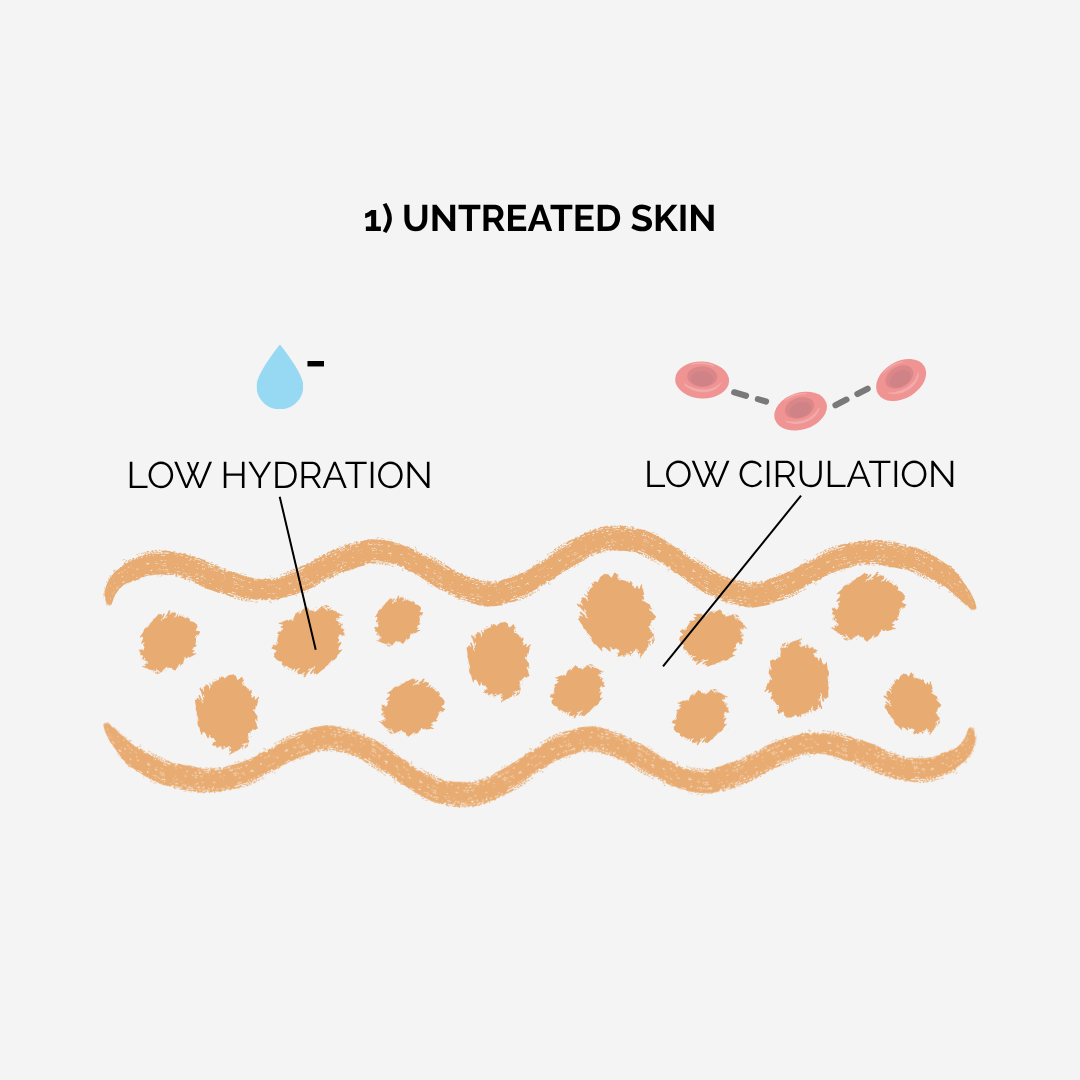 Diagram of untreated skin with low hydration and low circulation labeled.